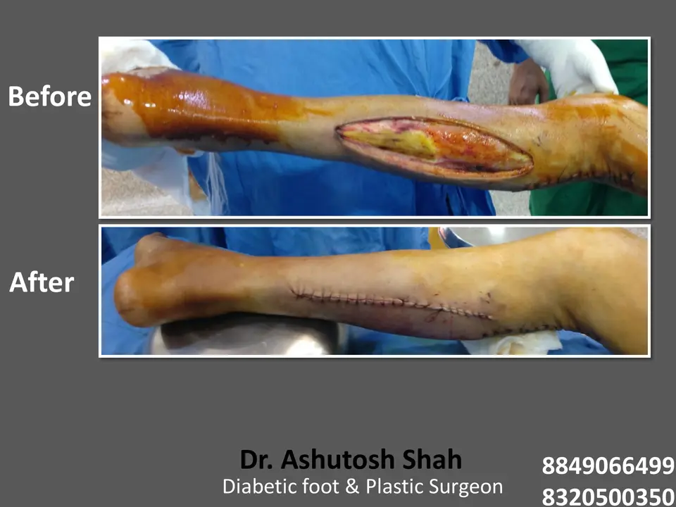 Diabetic Foot  PPT sunita.pptx-60.webp